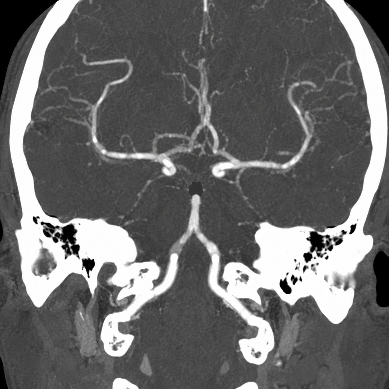 Synthetic CT angiography illustration of basilar artery occlusion
