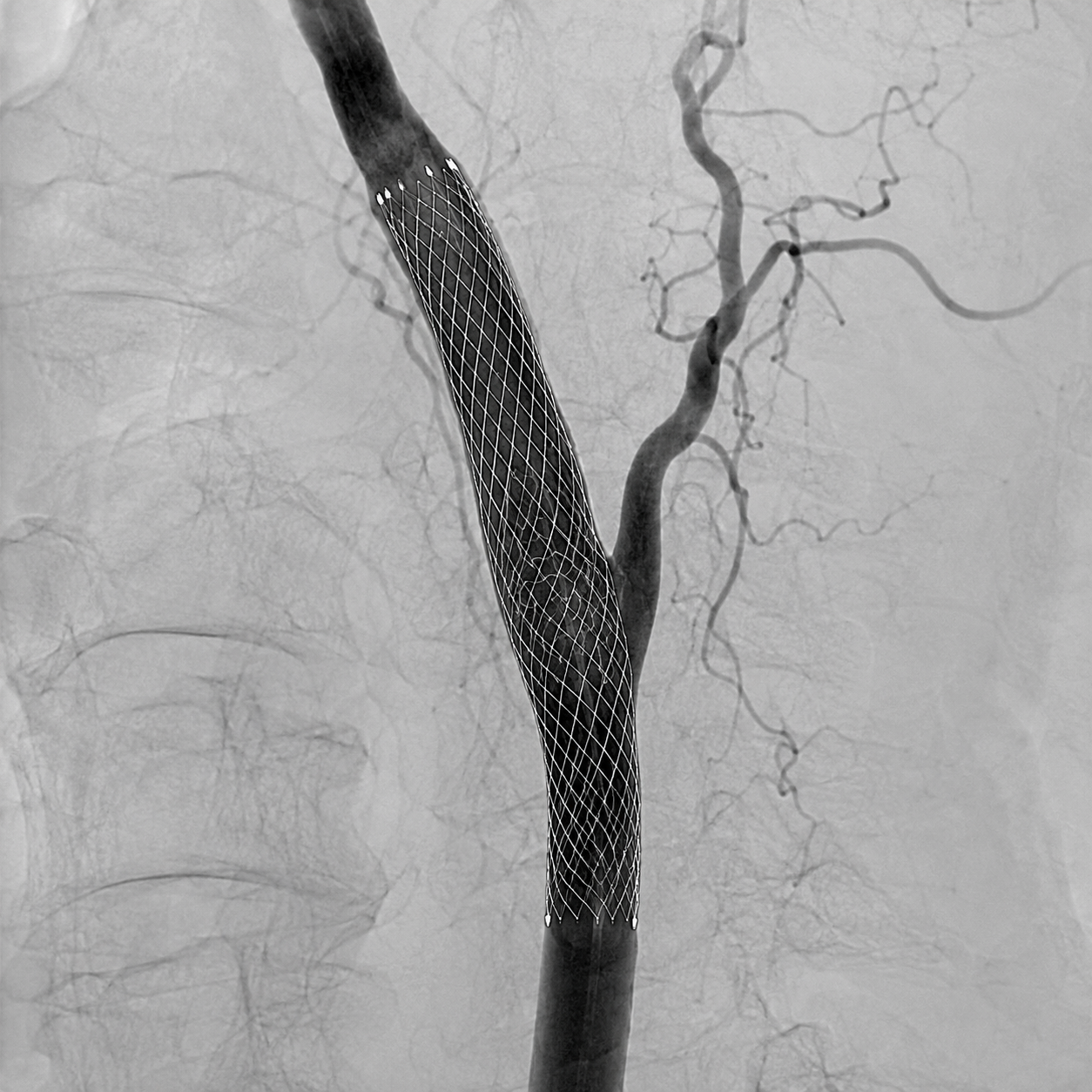 Synthetic angiographic and fluoroscopic illustration of a deployed stent across the carotid bulb and proximal cervical internal carotid artery