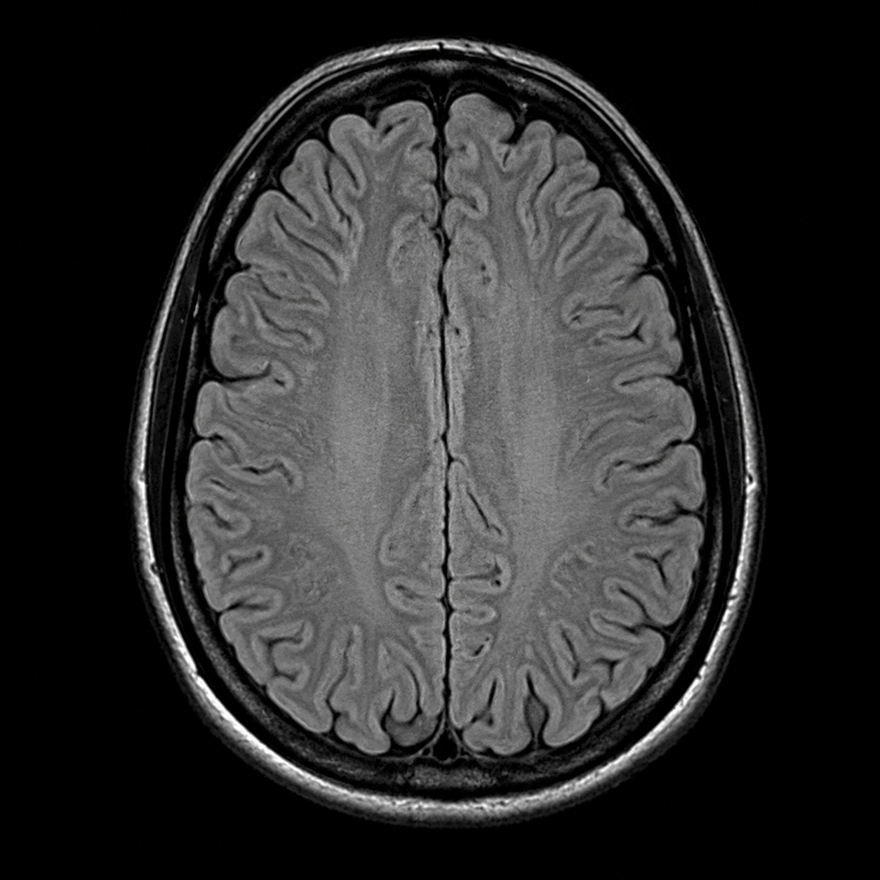 Synthetic axial 3T brain MRI FLAIR illustration