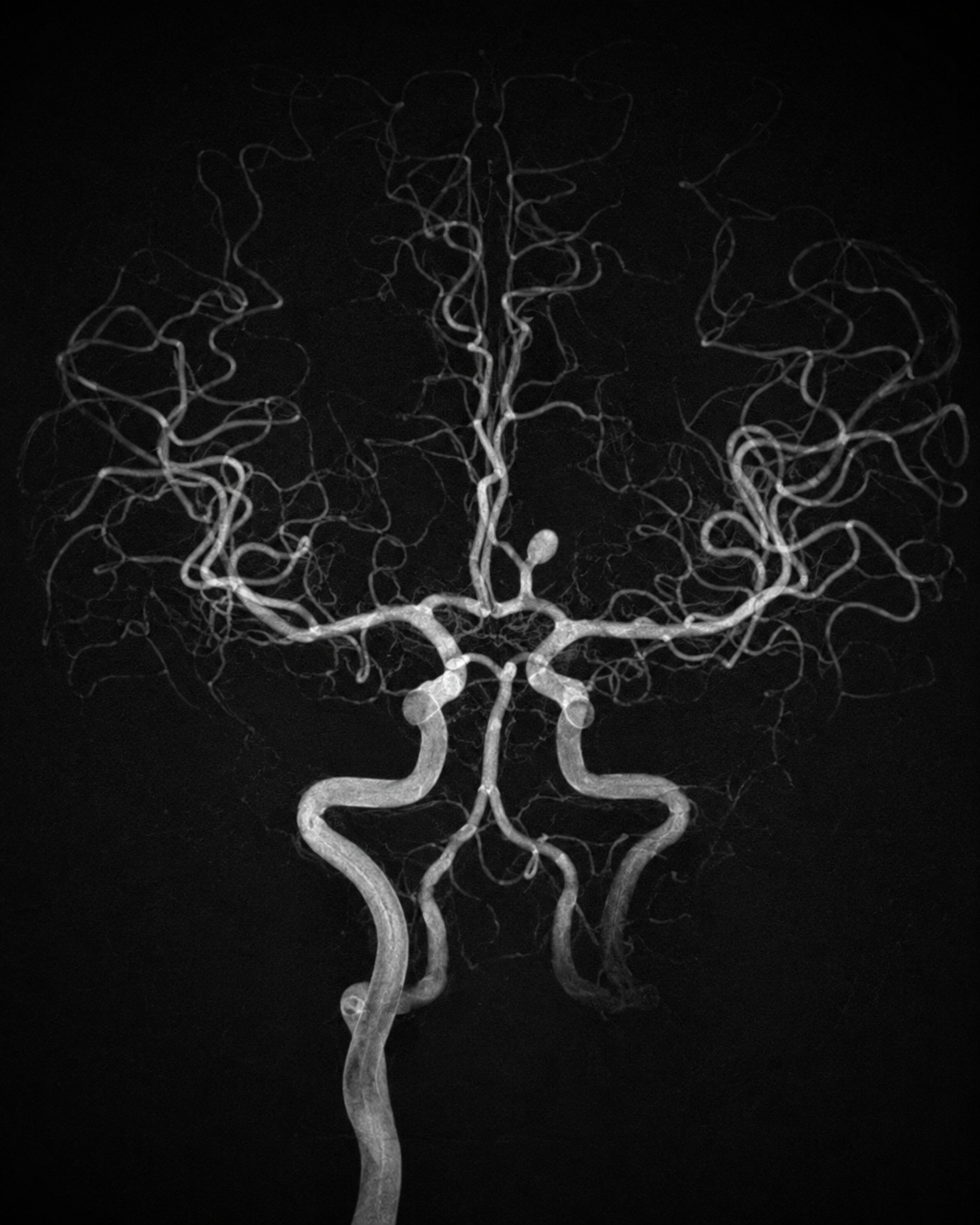 Synthetic digital subtraction angiography illustration of the cerebral circulation