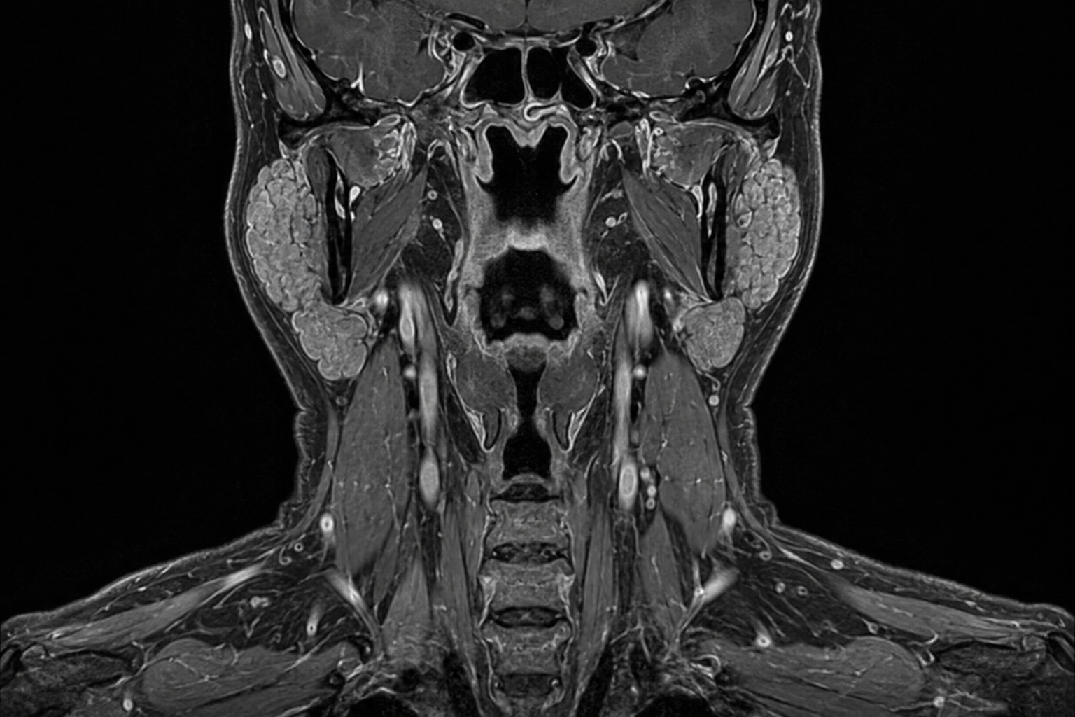 Synthetic coronal contrast-enhanced MRI illustration of the head and neck