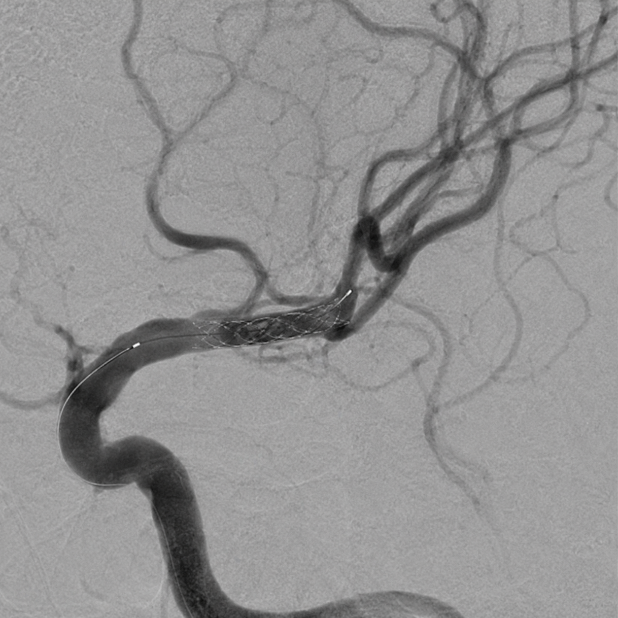 Synthetic magnified angiographic and fluoroscopic illustration of an expanded stent retriever spanning a left M1 thrombus