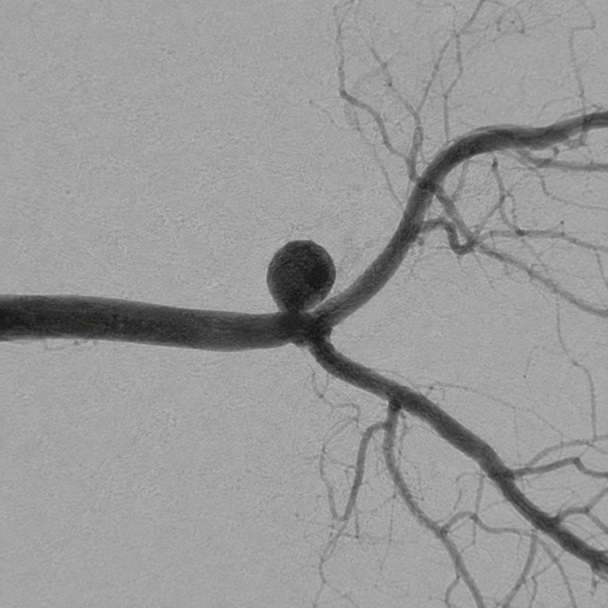 Synthetic DSA illustration of a saccular aneurysm at the distal M1 bifurcation of the middle cerebral artery