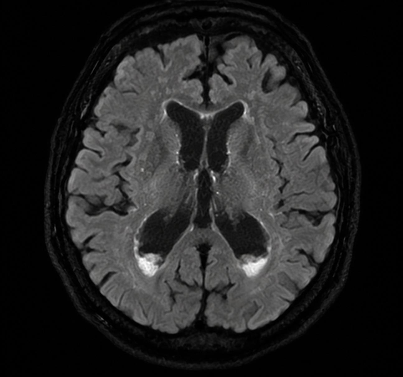 Synthetic axial diffusion MRI showing dependent intraventricular debris in ventriculitis