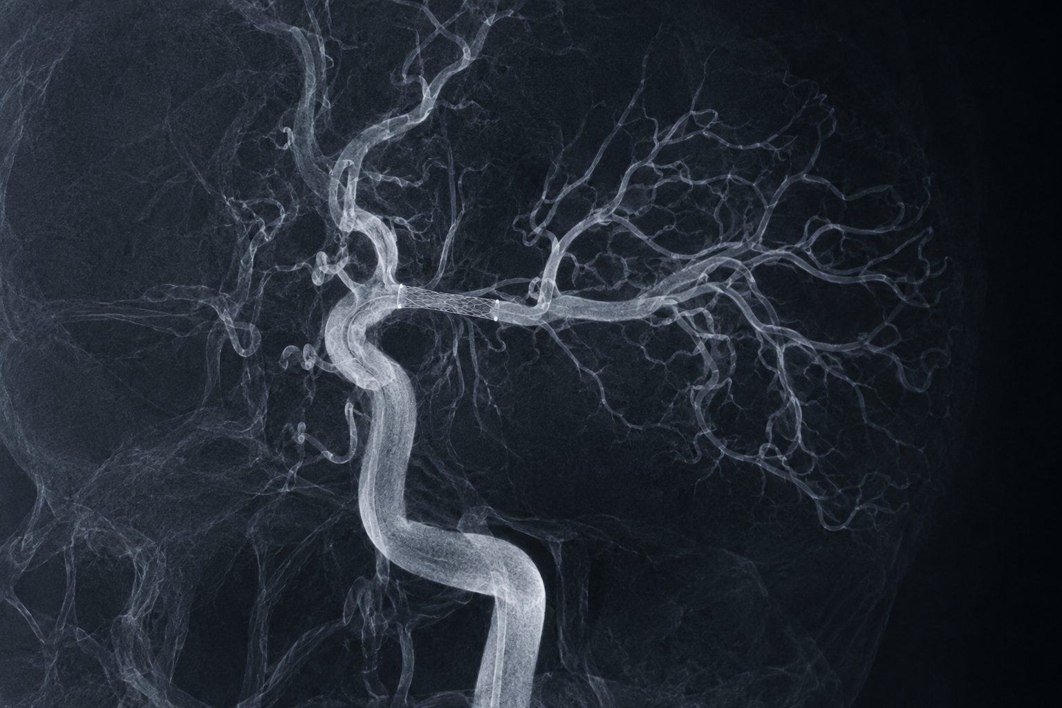Intracranial stenting & ICAD