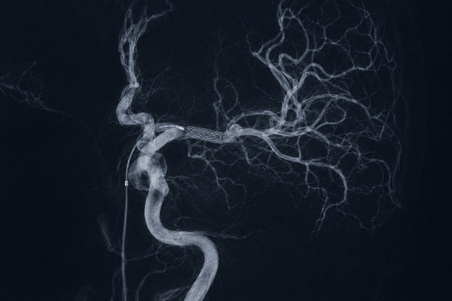 Rescue intracranial stenting
