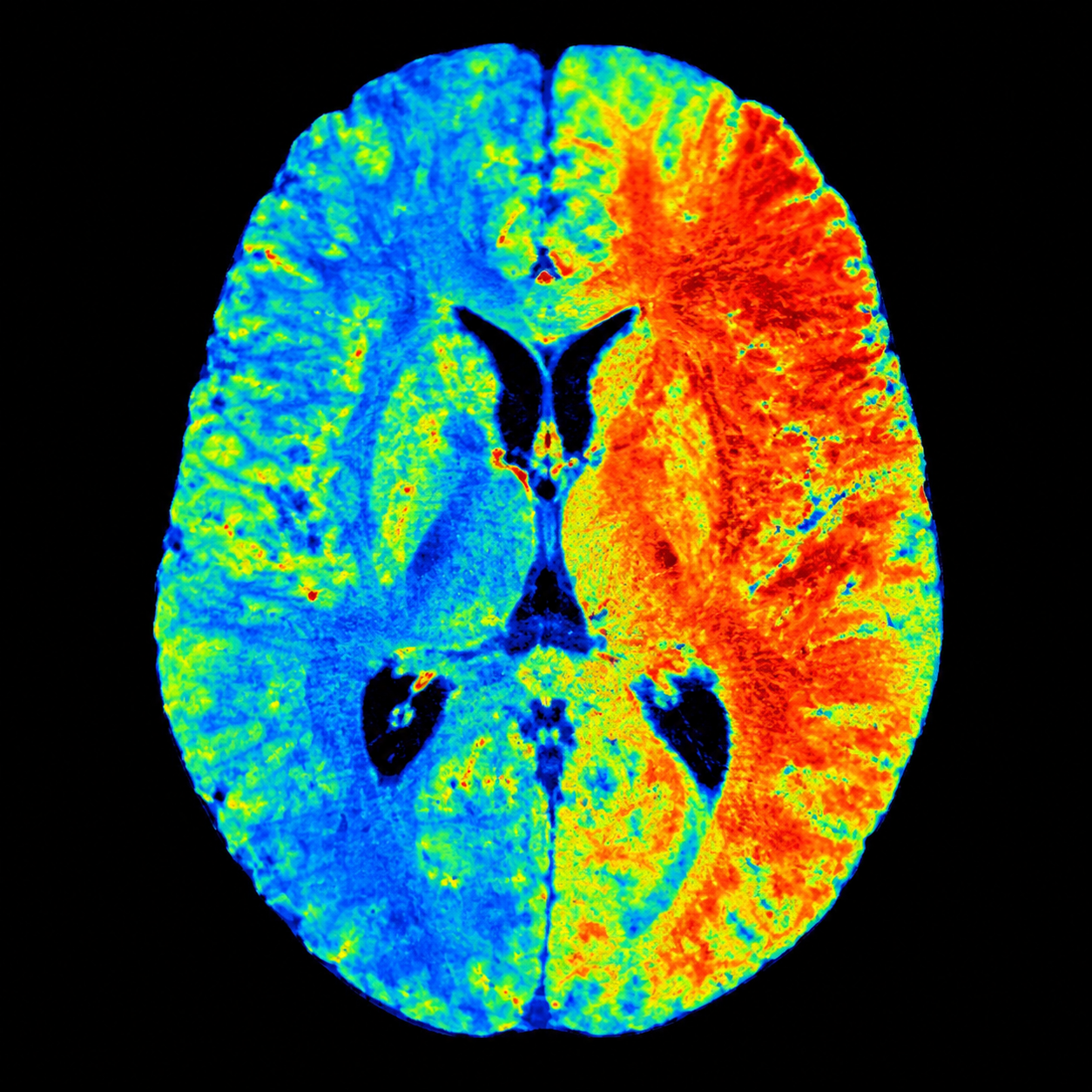 Synthetic cerebral perfusion mean transit time map